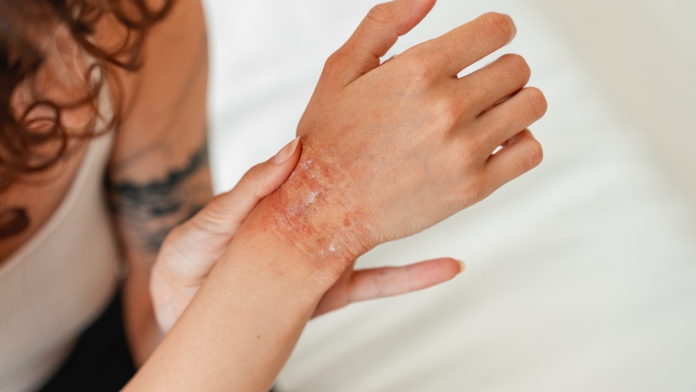 Peau Dermatite Atopique photo