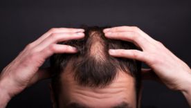 Alopécie, perte de cheveux : comment bien gérer ?